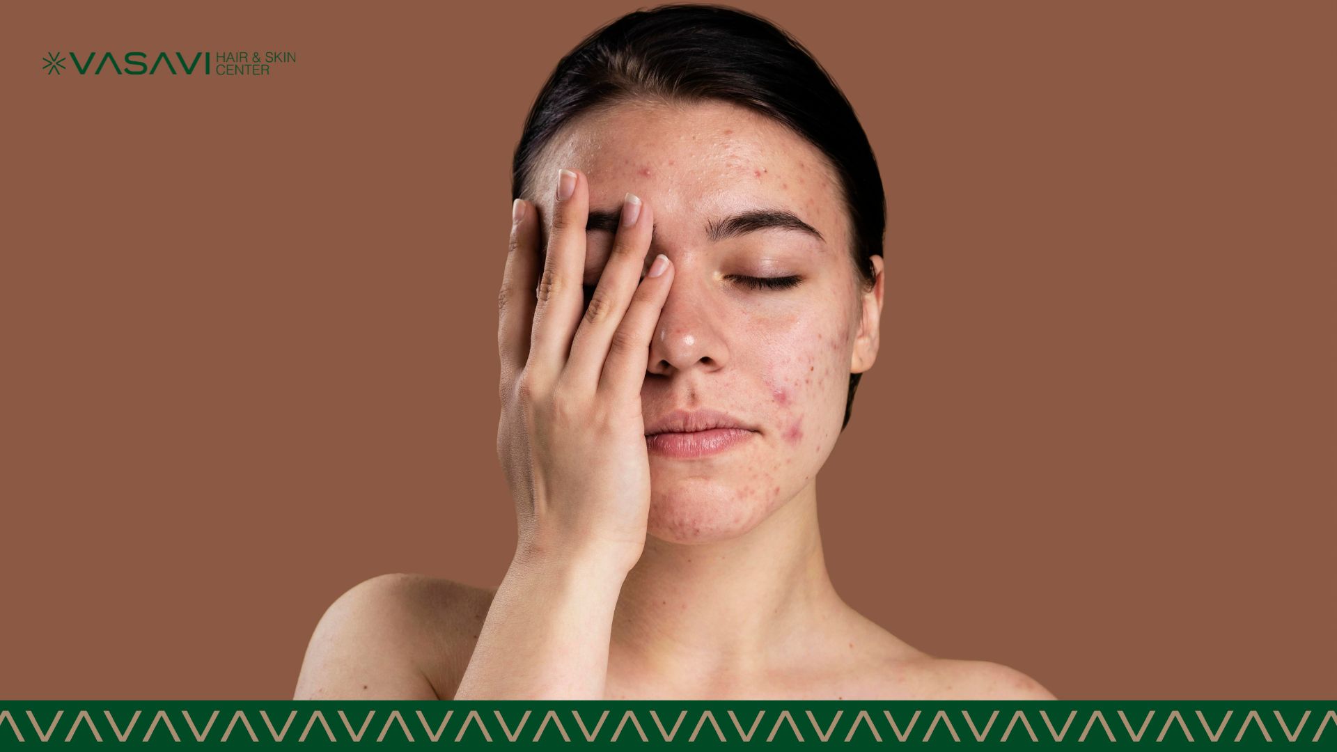 Effective Acne Scar Treatments