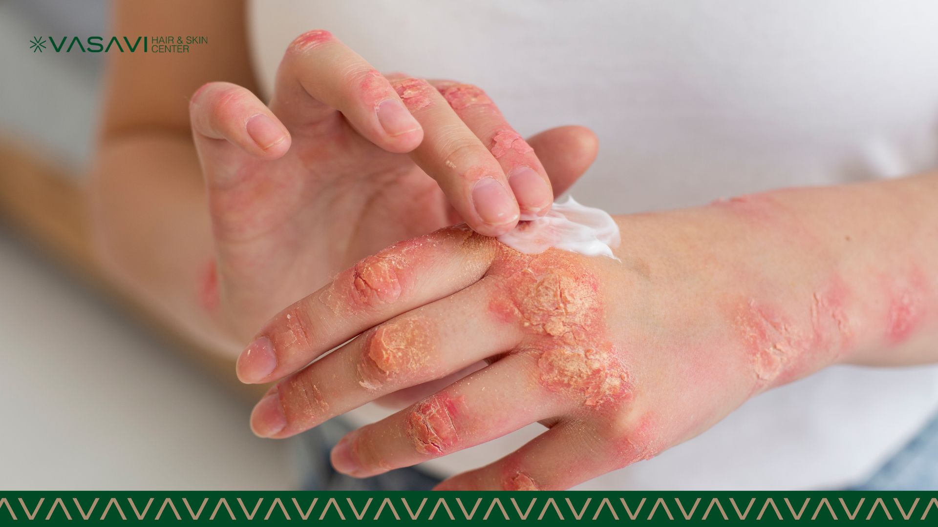 Living with Eczema Here's How to Manage and Treat It