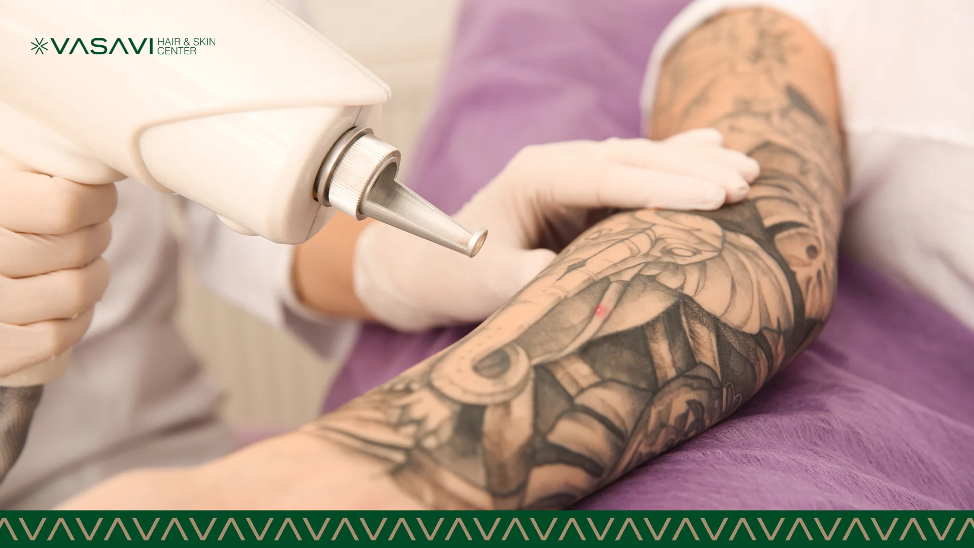 Professional Tattoo Removal Treatment in Bangalore