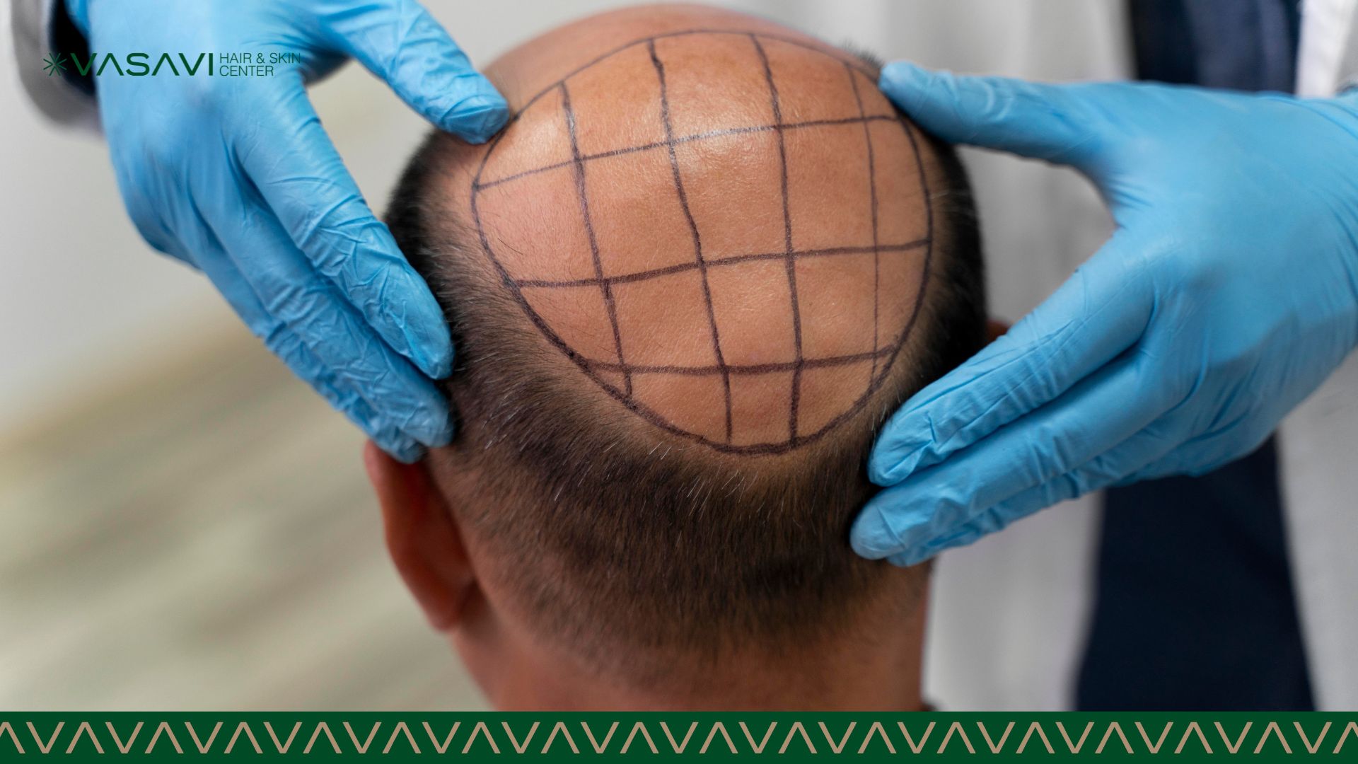 Hair Transplant | Vasavi