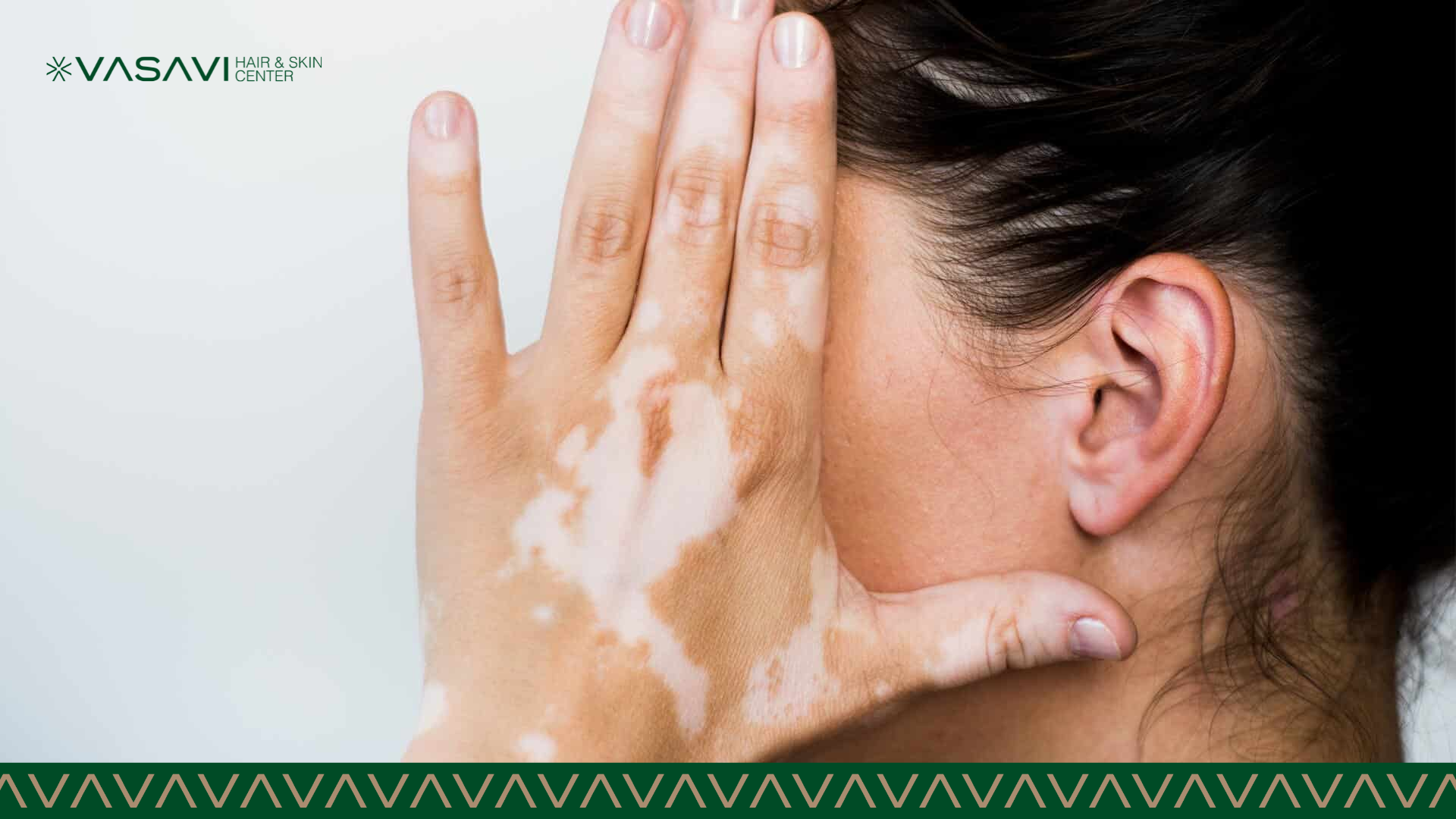 Vitiligo-Treatments