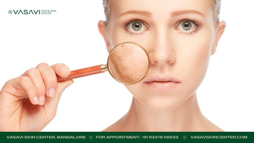 pengmentation come back