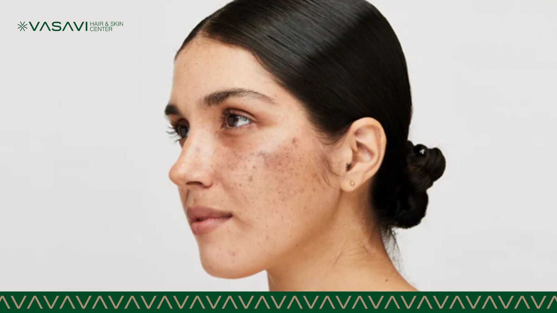 indian skin pegmentation